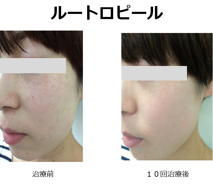 ルートロピール 美白治療 名古屋市昭和区の美容皮膚科