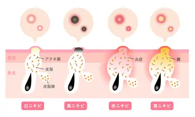 皮膚科医がオススメするニキビ市販薬とニキビの成り立ち 名古屋市昭和区の美容皮膚科