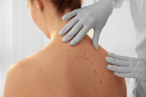 皮膚科で行う背中ニキビの治療